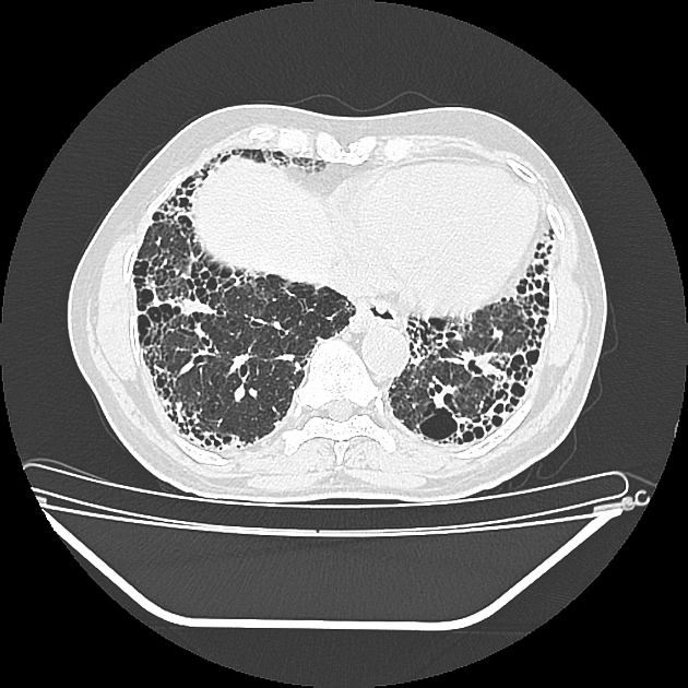 Artrite Reumatoide achados sistêmicos e extra articulares Blog Grupo