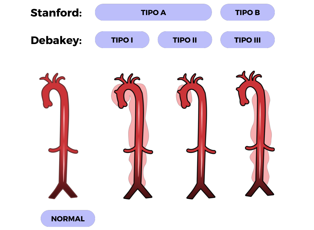 Classifica O De Stanford E Debakey Para A Dissec O De Aorta Blog