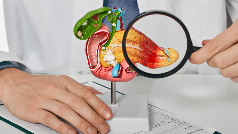 criterios gravidade pancreatite, necrose pancreatica, sintomas de pancreatite alcoólica, pancreatite aguda, pancreatite tratamento, Antibióticos para Pancreatite aguda, infecção da necrose, qual o tratamento para pancreatite, infecção no pancreas,