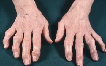 Osteoartrite na mão