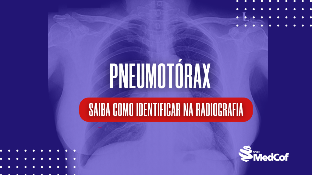 pneumotórax, pneumotórax hipertensivo, pneumotórax espontâneo, pneumotórax traumático, pneumotórax causas, pneumotórax raio x