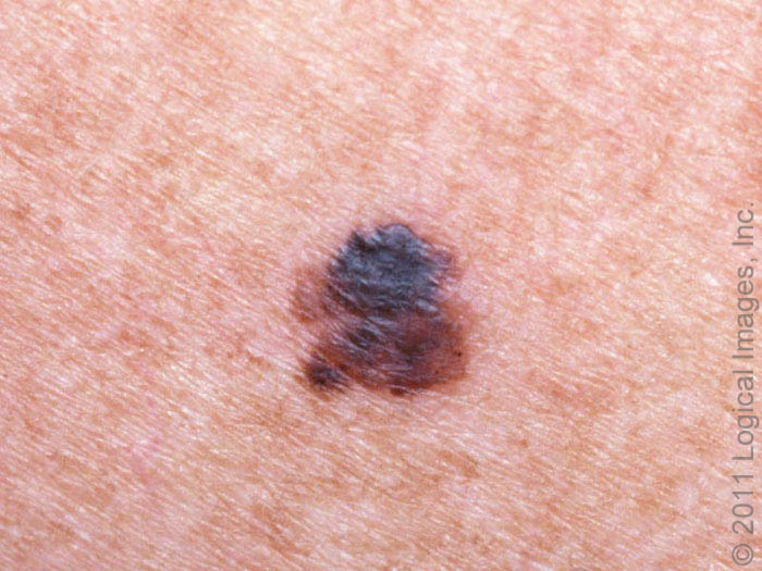 melanoma, cancer de pele melanoma, fotos de câncer de pele melanoma, fotos melanoma, melanona de pele, cancer melanoma, melanoma cancer de pele