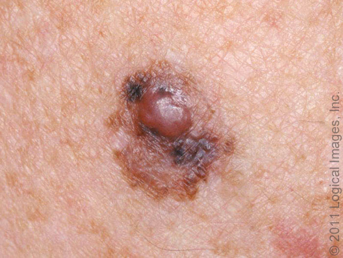 melanoma, cancer de pele melanoma, fotos de câncer de pele melanoma, fotos melanoma, melanona de pele, cancer melanoma, melanoma cancer de pele