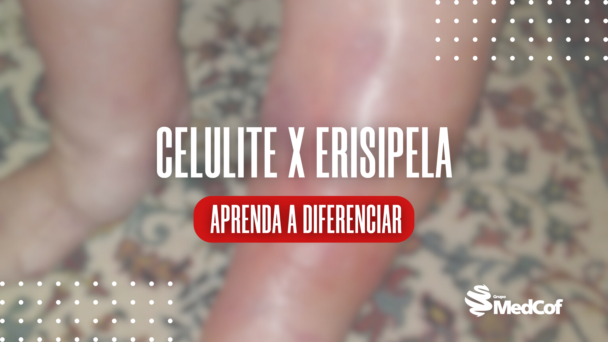 Celulite X Erisipela: aprenda a diferenciar - Blog de Medcof: conteúdos ...