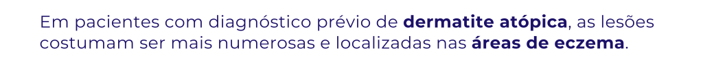 sindrome do pé mão e boca, Síndrome mão-pé-boca, síndrome mão-pé-boca complicações, síndrome mão pé boca, síndrome mão-pé-boca, síndrome mão pé e boca,