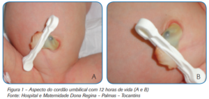 Atualizações: higiene do cordão umbilical no recém-nascido - Blog Grupo ...