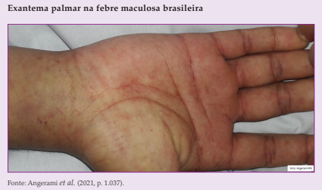 Exantema palmar na febre maculosa brasileira