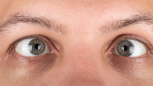olhos-síndrome-de-miller-fisher